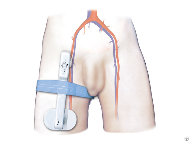 Electronic Femoral Hemostasis Compression Device