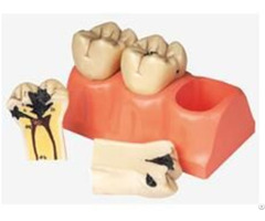 Jy B10009 Dissected Model Of Dental Caries