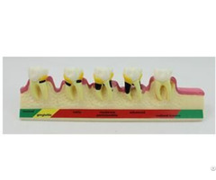 Jy B10014 Periodontal Disease Model