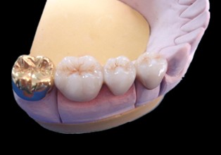 Dental Fixed Porcelain Gold Crown Precious Metal Denture And Bridge