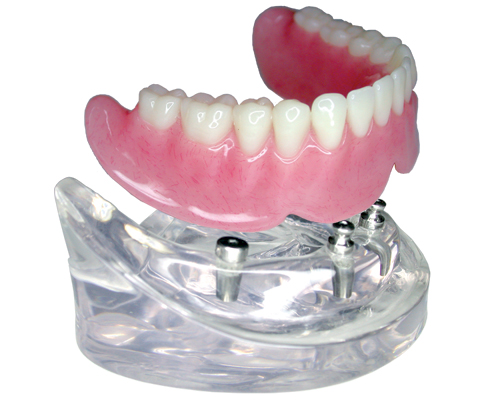 Dental Implant Casting Abutment All Ceramic Crown