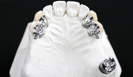 Dental Precision Attachment With Partial Denture