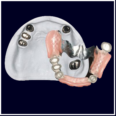 Dental Telescope Inner Outer Crown With Partial Removable Acrylic Denture