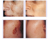 Dermatology Laser 15w