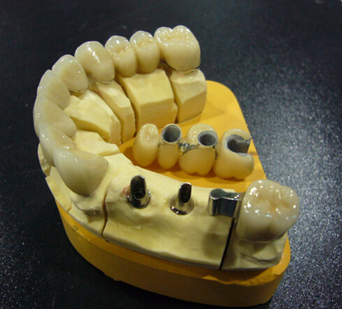 Implant Crown On Sale Only Need Euro 60 Including Shipping