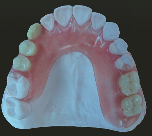 Valplast Denture On Sale Only Need Euro 40 Including Shipping