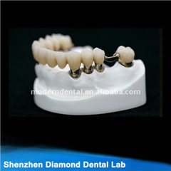 Dental Implant Crown And Bridge
