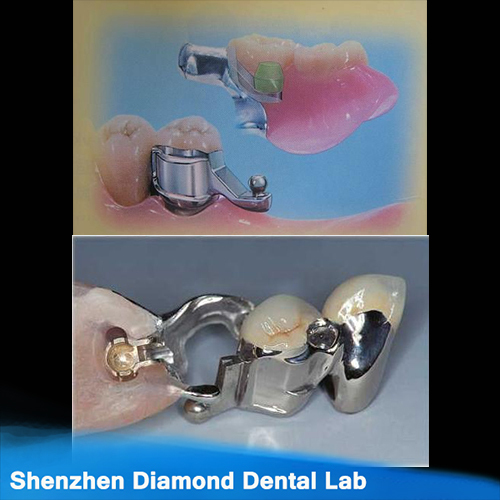 Dental Precision Attachment Crowns